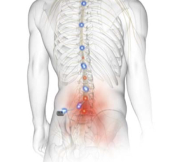 脊髓刺激可改善手臂功能