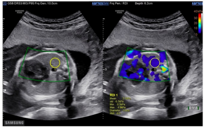 European Radiology:孕24~39<font color="red">周</font>胎儿肺和肝的弹性SWE定量