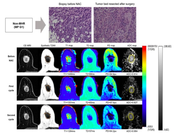 European Radiology:平扫MRI定量<font color="red">参数</font>在早期预测乳腺癌新辅助化疗<font color="red">病理</font>反应中的价值