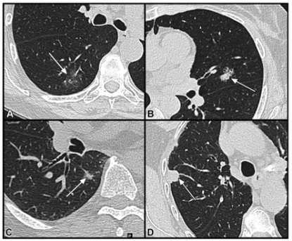 Radiology：临床I期肺腺癌的CT放射基因组分析及其组织病理学特征