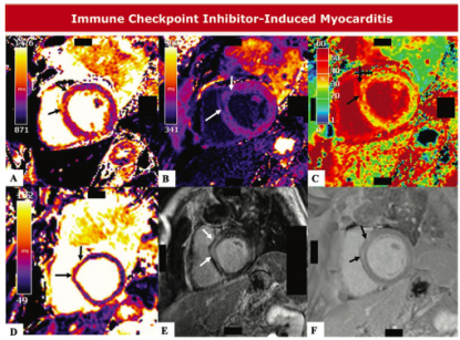 Radiology：免疫检查点抑制剂<font color="red">诱发</font>心肌炎的心脏MRI特征及预后价值