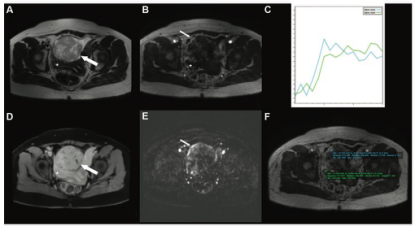 Radiology：附件病变的O-RADS MRI分型