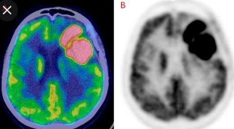 neurology：如何通过MRI区分高等级（WHO 3-4级）胶质瘤进展和治疗效果？