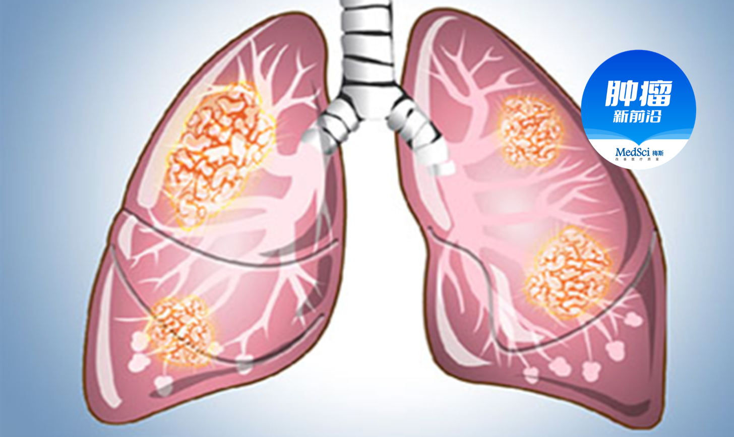 从1个肺小结节，发展成肺癌，需要几年？