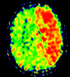 Alzheimer&Dementia：大脑氧提取<font color="red">分数</font>变化与血管和阿尔茨海默病的关系