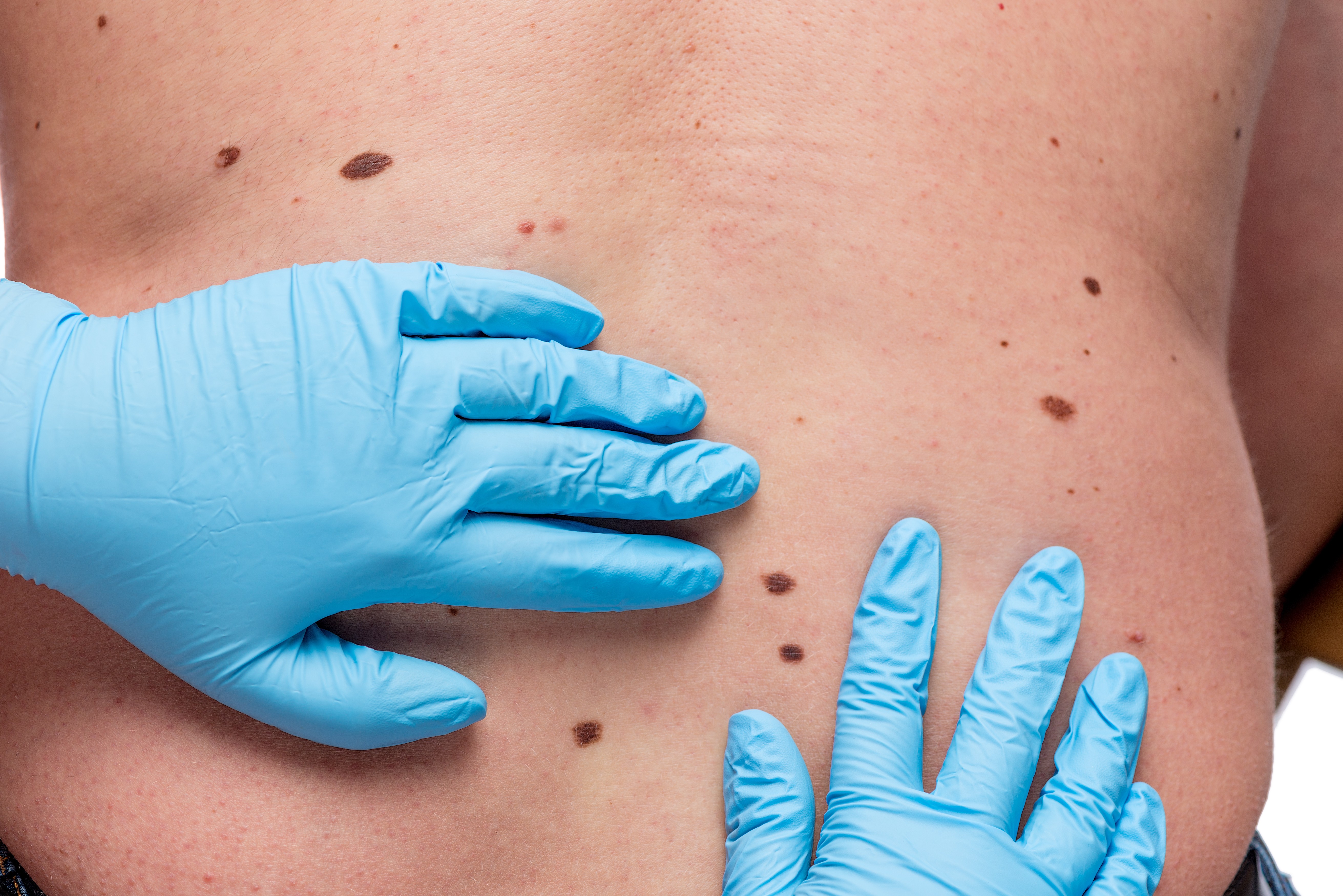 黑色素细胞性皮肤肿瘤的治疗研究进展