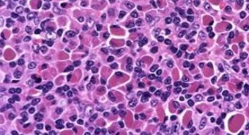 Lancet Oncol：双抗Mosunetuzumab治疗复发或难治性滤泡性淋巴瘤的疗效