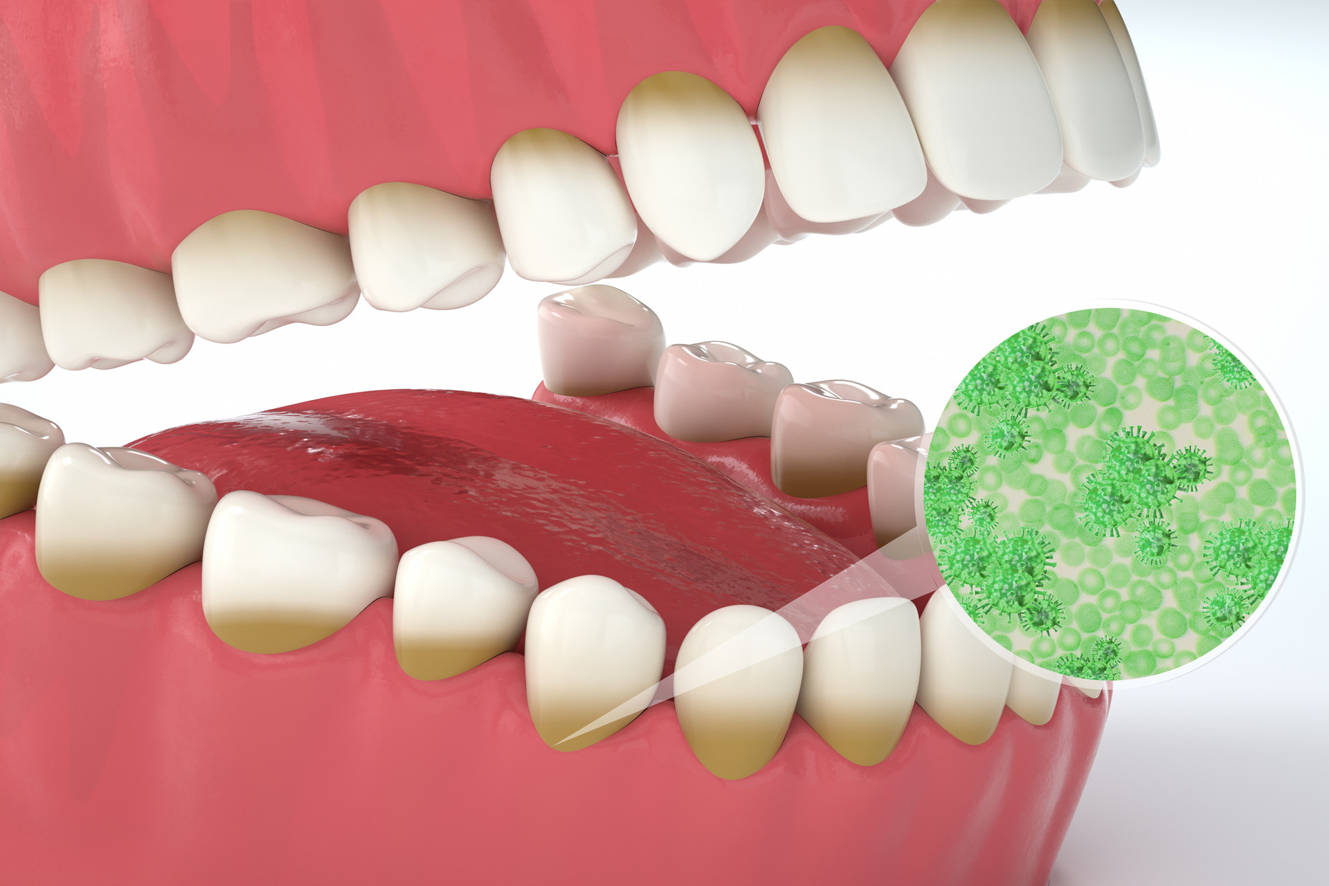 J Clin Periodontol：严重牙周炎致牙齿病<font color="red">理性</font>移位和伸长，联合正畸治疗的效果