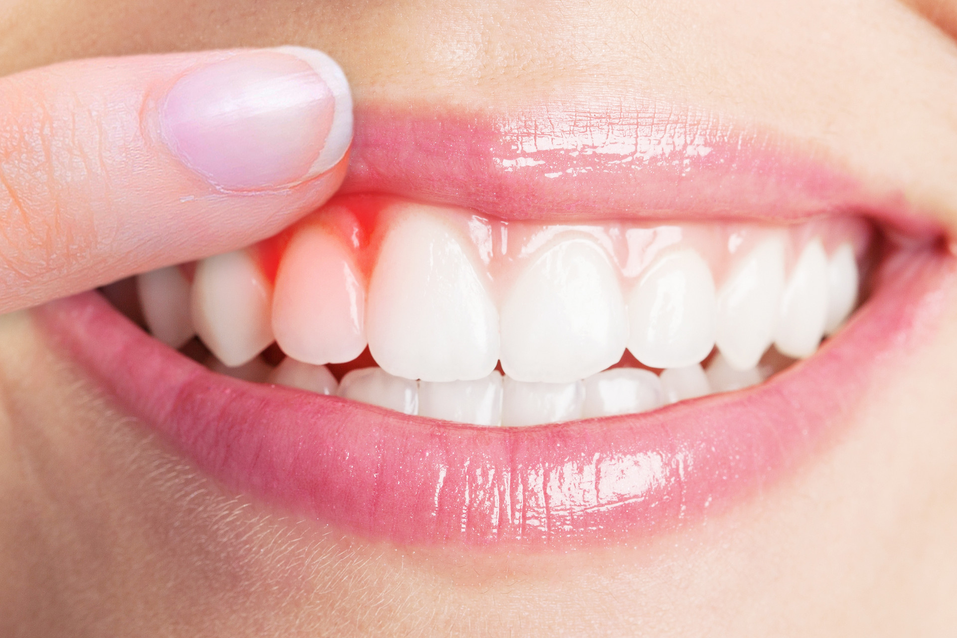 J Periodontal Res：使用欧米茄-3脂肪酸作为非手术牙周治疗的辅助手段，是否能为牙周炎的治疗带来额外益处？