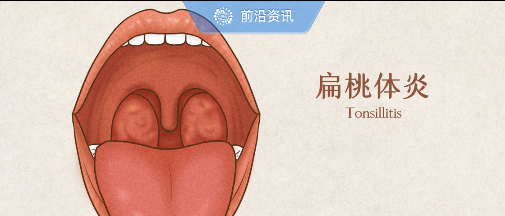 疼起来要命！扁桃体除了发炎，还能干什么？