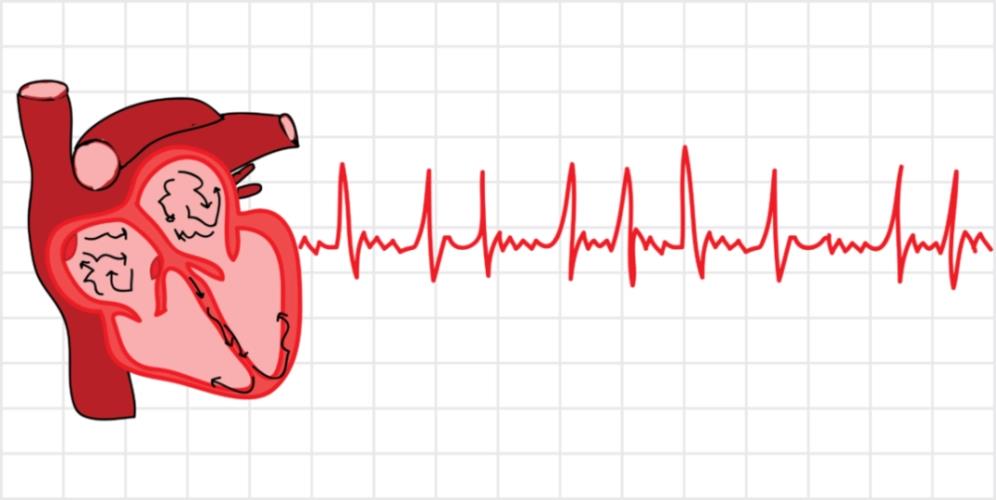 BMJ Heart：慢性肾脏疾病患者房颤与<font color="red">肾功能</font><font color="red">下降</font>的关系