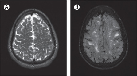 Lancet neurology：脑淀粉样血管病的波士顿<font color="red">标准</font>2.0版新<font color="red">标准</font><font color="red">研究</font>