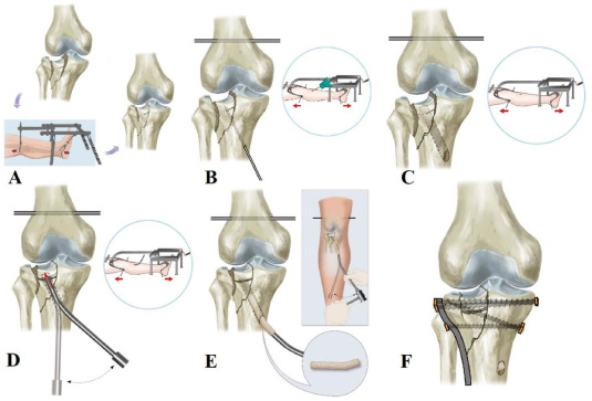 Journal of Orthopaedic Translation:微创手术加双反向牵引复位器治疗胫骨平台骨折疗效更好