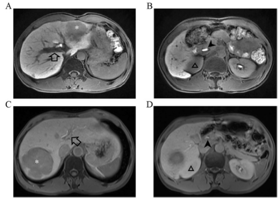 European Radiology：肝功能成像评分在预测HCC切除术后肝功能衰竭方面的价值