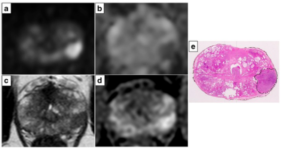 European Radiology：多参数磁共振<font color="red">成像</font>实现前列腺癌的病理级预测！
