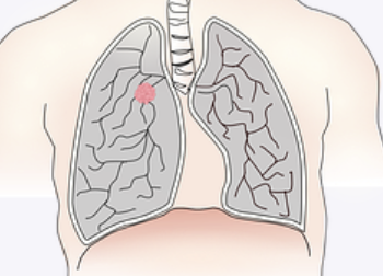 《<font color="red">围</font>手术期非小细胞肺癌国际专家诊疗共识》即将重磅发布