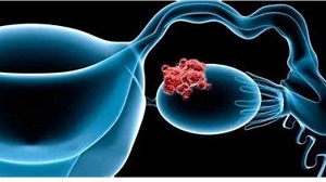 Clin Cancer Res：西地尼布联合奥拉帕利治疗晚期铂耐药卵巢癌的疗效