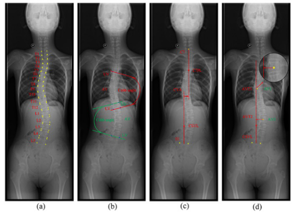 European Radiology：深度学习在诊断青少年特发性脊柱侧弯中的应用