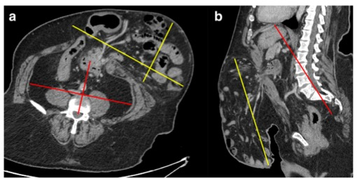 European Radiology：术前的CT测量值是否与后续腹疝修补术的成功或失败有关？