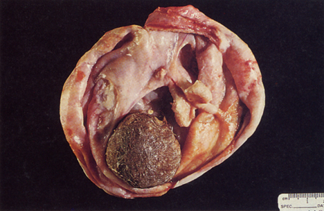 畸胎瘤是最常见的生殖细胞肿瘤类型,多数畸胎瘤为良性