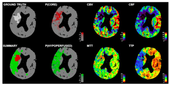 European Radiology：CTP在缺血性脑卒中区域分类中的<font color="red">价值</font>