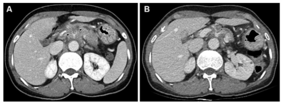 Radiology：CT+CA19-9的强强联手：非转移性胰腺癌的治疗反应评估