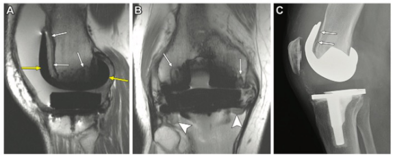 Radiology：MRI对全膝关节置换术假体松动的诊断价值