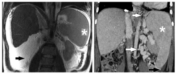 Radiology：Fontan循环的腹部CT和MRI表现