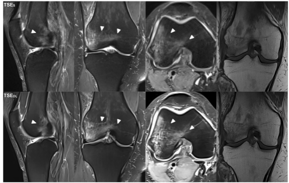 European Radiology：使用深度学习，让膝关节MRI实现“又快又好”！