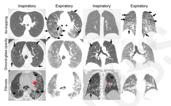 Radiology：胸部CT定量评估急性SARS-CoV-2感染后小气道病变的存在