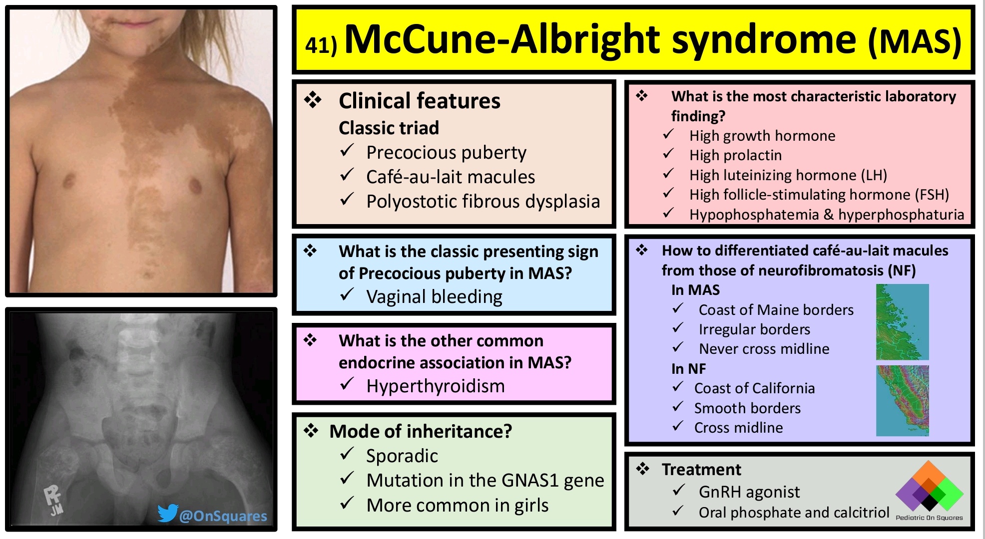 McCune-Albright综合征：临床症状及体征、流行病学、病因、诊断及治疗