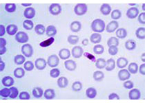 转氨酶<font color="red">高</font>，就是得肝炎了吗？