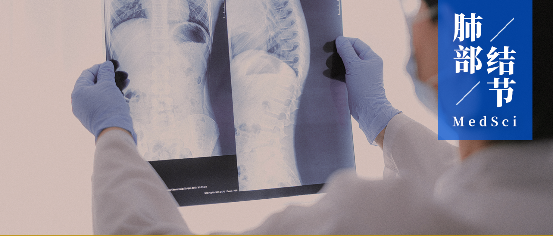 15个常见的恶性肺结节影像特征 | 建议收藏