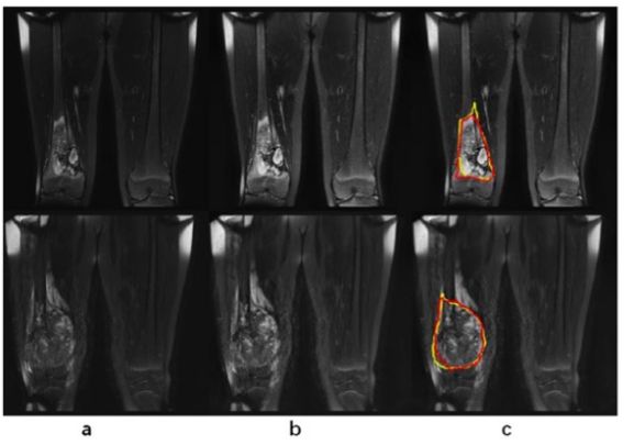 European Radiology：利用深度学习和基于MRI的放射组学<font color="red">列</font>线图自动预测骨肉瘤的新辅助化疗反应
