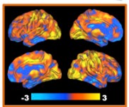 JAMA Neuro：Aβ水平的空间范围以及与Tau-PET和认知的相关性研究