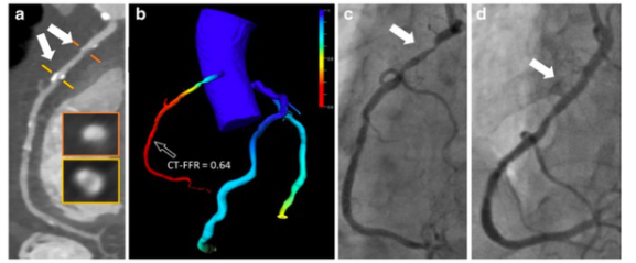 European Radiology：基于机器学习的CT-FFR对TAVR术严重主动脉狭窄患者决策的影响