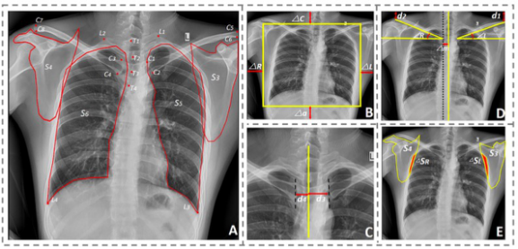 European Radiology：基于深度学习和线性回归级联算法的胸片自动质量评估