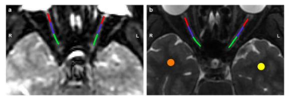 European Radiology：<font color="red">DTI</font>在视神经脊髓炎谱系疾病和多发性硬化症鉴别中的价值