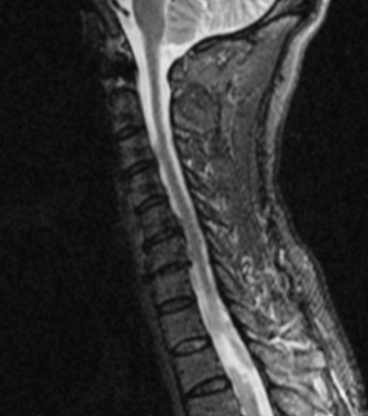 Neurology：朱永坚团队发现自发性脊柱硬膜外血肿的预后因素