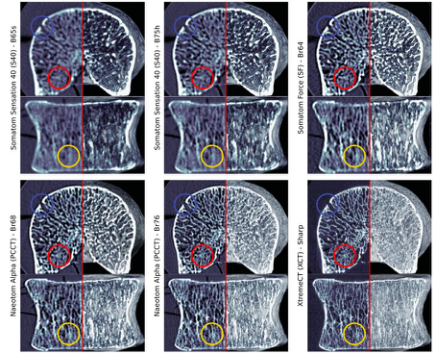 Investigative Radiology：光子计数CT在骨小梁结构成像中的应用