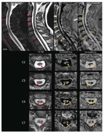 Investigative Radiology：这一MR技术，为多发性硬化的颈髓病变显示“加装备”！