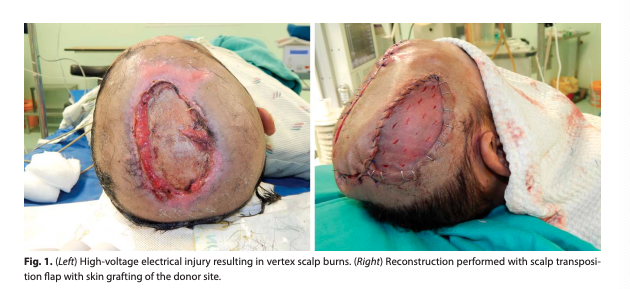 PRS：治疗头皮和颅骨电击伤的经验