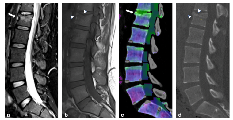 Eur Radiol：双能计算机断层扫描和磁共振成像评估急性椎体骨折骨髓水肿和骨折线的综合比较