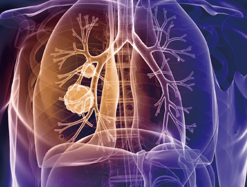 ERS上呈报的CONVERT临床试验数据显示，AeriSeal系统治疗晚期慢性阻塞性肺病/肺气肿患者取得初步成功