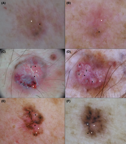 Exp Dermatol ：类似黑色素瘤的基底细胞癌的皮肤镜特征