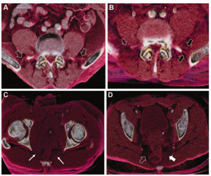 Radiology：双能量CT和图像渲染在评估骨盆骨折不稳定性方面的价值