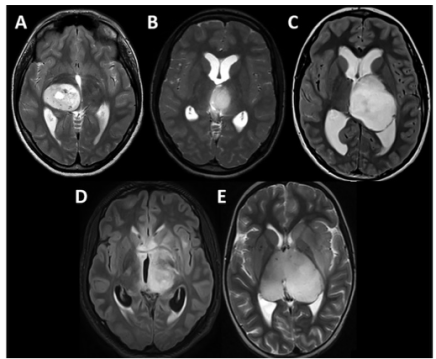 Radiology：小儿丘脑高级别胶质瘤的<font color="red">MRI</font>和分子特征