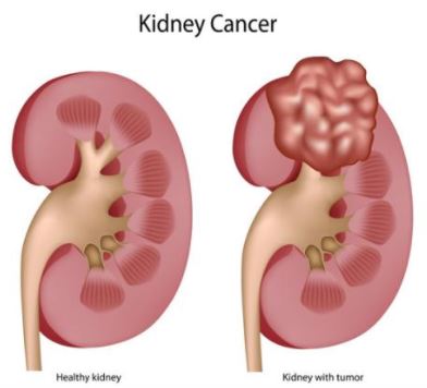 JAMA Oncol：Telaglenstat联合<font color="red">卡</font><font color="red">博</font><font color="red">替</font><font color="red">尼</font>治疗转移性晚期肾细胞癌