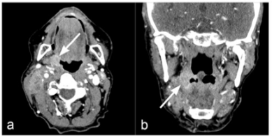 European Radiology：头颈部单能量和双能量CT图像质量的比较
