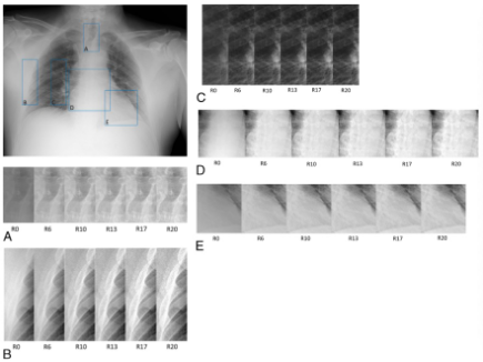 Investigative Radiology：如何利用先进的影像技术提高床旁胸部x线片的图像质量？